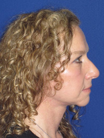 Facelift/Mini-Facelift Before & After Gallery - Patient 254891 - Image 6