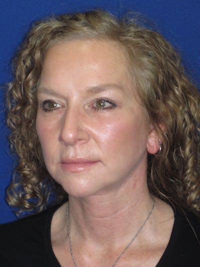Facelift/Mini-Facelift Before & After Gallery - Patient 254891 - Image 8