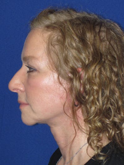Facelift/Mini-Facelift Before & After Gallery - Patient 254891 - Image 10