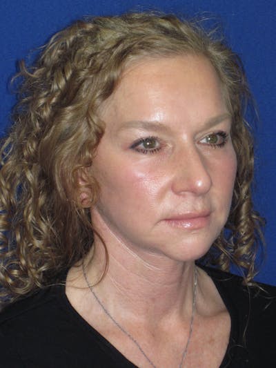 Facelift/Mini-Facelift Before & After Gallery - Patient 254891 - Image 4