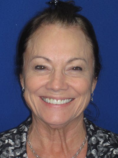 Facelift/Mini-Facelift Before & After Gallery - Patient 314486 - Image 1