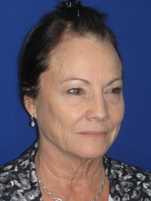 Facelift/Mini-Facelift Before & After Gallery - Patient 314486 - Image 3