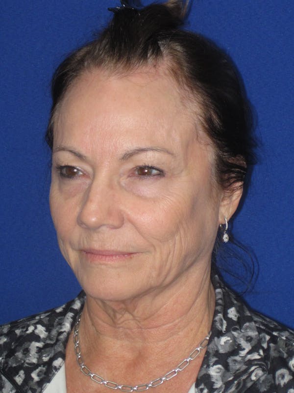 Facelift/Mini-Facelift Before & After Gallery - Patient 314486 - Image 7