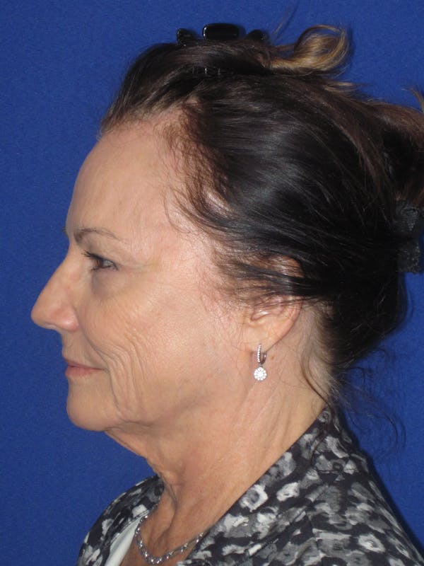 Facelift/Mini-Facelift Before & After Gallery - Patient 314486 - Image 9
