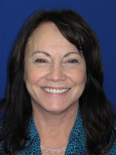 Facelift/Mini-Facelift Before & After Gallery - Patient 314486 - Image 2