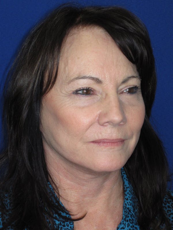 Facelift/Mini-Facelift Before & After Gallery - Patient 314486 - Image 4