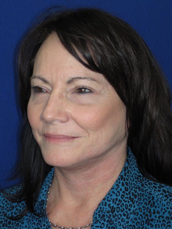 Facelift/Mini-Facelift Before & After Gallery - Patient 314486 - Image 8