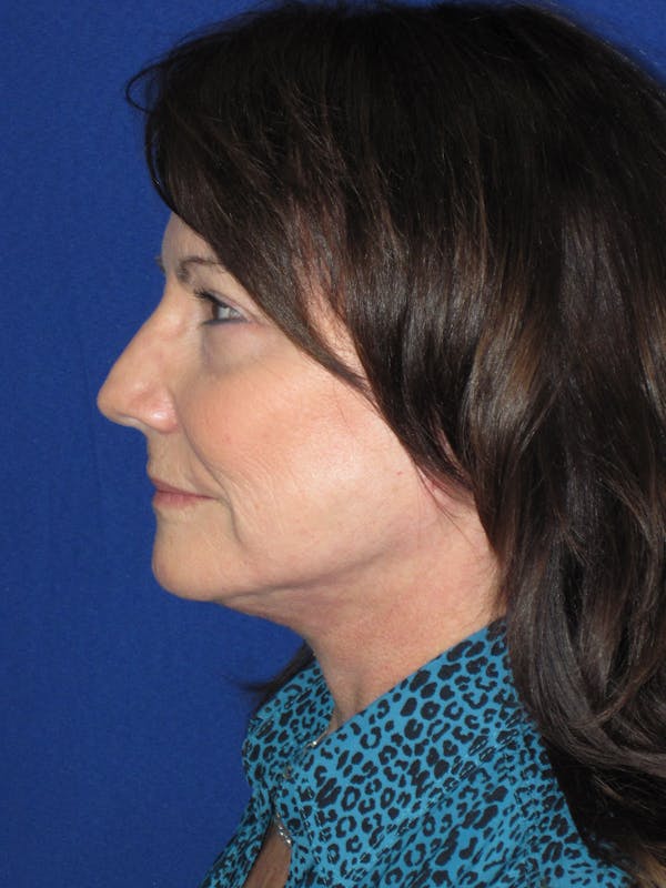 Facelift/Mini-Facelift Before & After Gallery - Patient 314486 - Image 10