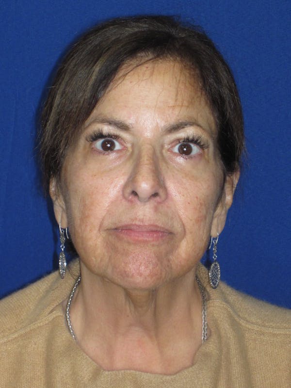 Facelift/Mini-Facelift Before & After Gallery - Patient 333521 - Image 3