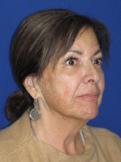 Facelift/Mini-Facelift Before & After Gallery - Patient 333521 - Image 1
