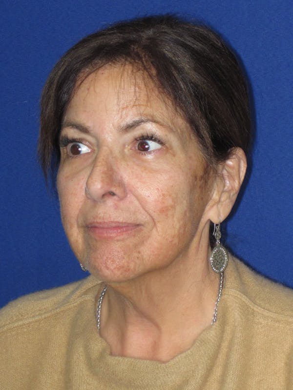 Facelift/Mini-Facelift Before & After Gallery - Patient 333521 - Image 5