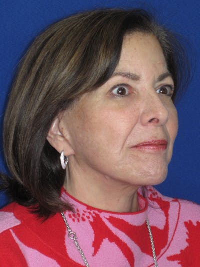 Facelift/Mini-Facelift Before & After Gallery - Patient 333521 - Image 2