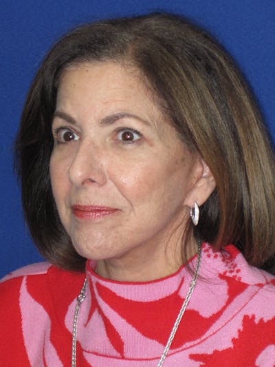 Facelift/Mini-Facelift Before & After Gallery - Patient 333521 - Image 6