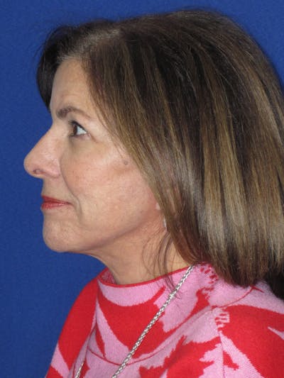 Facelift/Mini-Facelift Before & After Gallery - Patient 333521 - Image 8