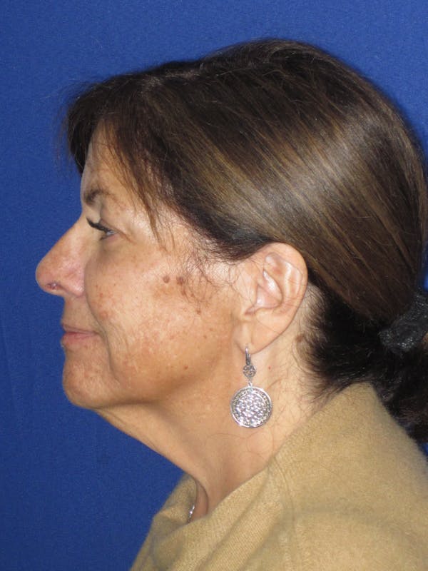 Facelift/Mini-Facelift Before & After Gallery - Patient 333521 - Image 7