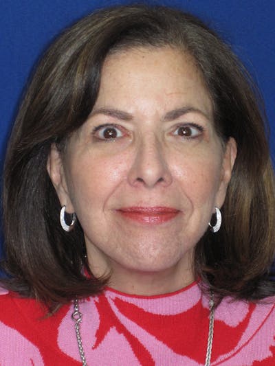 Facelift/Mini-Facelift Before & After Gallery - Patient 333521 - Image 4