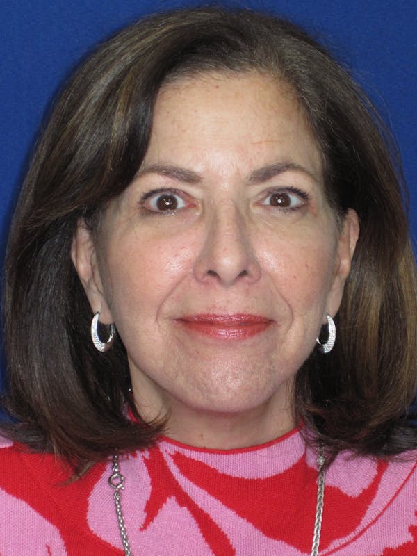 Facelift/Mini-Facelift Before & After Gallery - Patient 333521 - Image 4