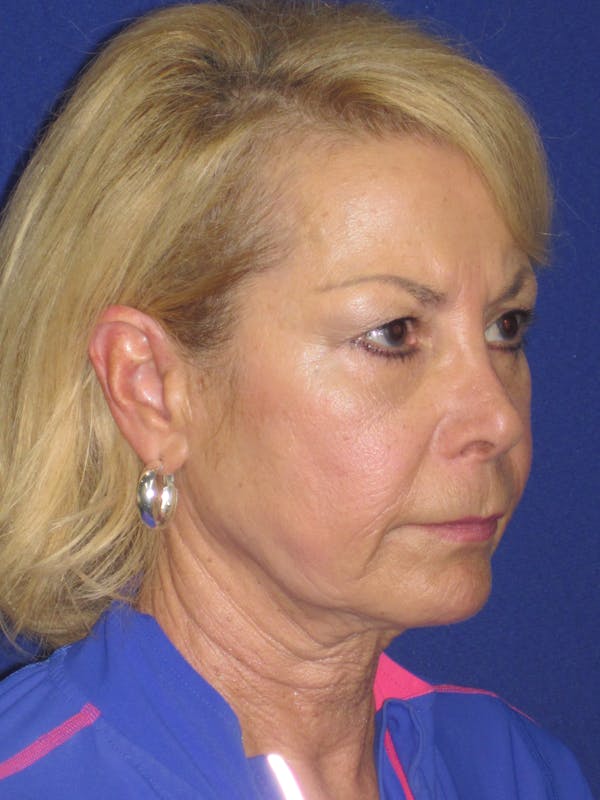 Facelift/Mini-Facelift Before & After Gallery - Patient 312379 - Image 3