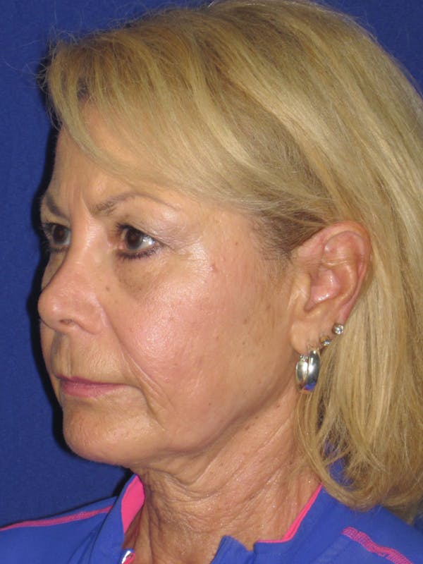 Facelift/Mini-Facelift Before & After Gallery - Patient 312379 - Image 7