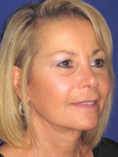 Facelift/Mini-Facelift Before & After Gallery - Patient 312379 - Image 4