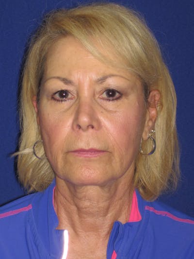 Facelift/Mini-Facelift Before & After Gallery - Patient 312379 - Image 1