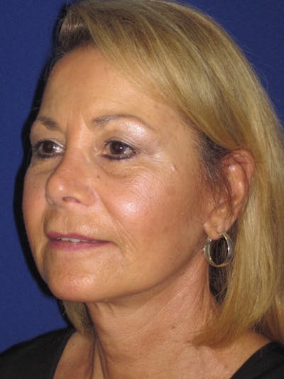 Facelift/Mini-Facelift Before & After Gallery - Patient 312379 - Image 8
