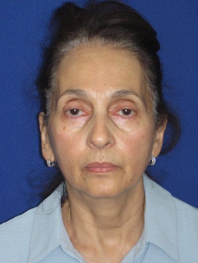 Facelift/Mini-Facelift Before & After Gallery - Patient 961689 - Image 1