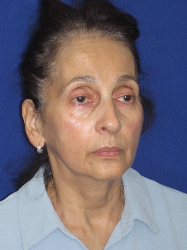 Facelift/Mini-Facelift Before & After Gallery - Patient 961689 - Image 3