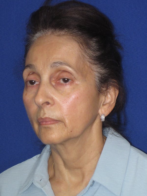 Facelift/Mini-Facelift Before & After Gallery - Patient 961689 - Image 5