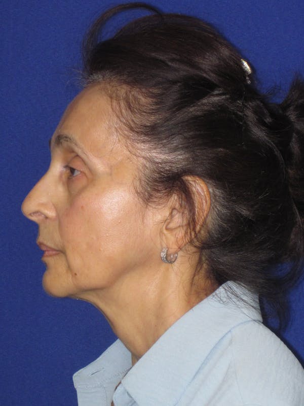 Facelift/Mini-Facelift Before & After Gallery - Patient 961689 - Image 7