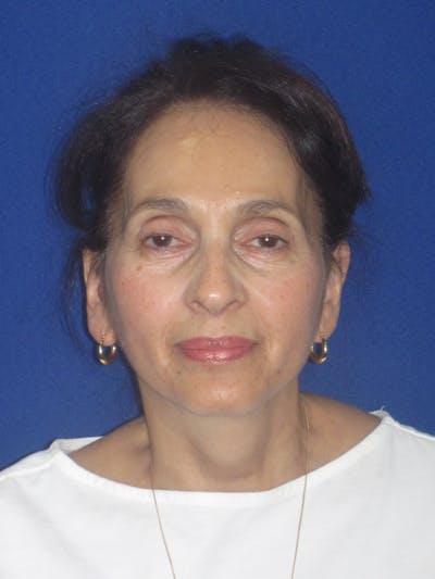 Facelift/Mini-Facelift Before & After Gallery - Patient 961689 - Image 2