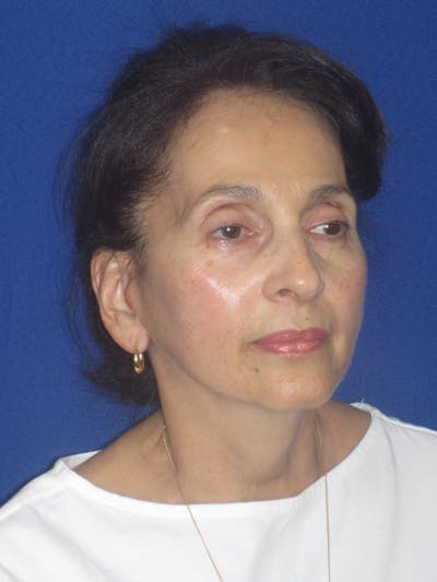 Facelift/Mini-Facelift Before & After Gallery - Patient 961689 - Image 4