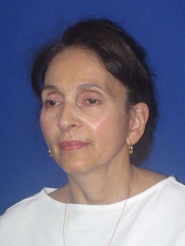 Facelift/Mini-Facelift Before & After Gallery - Patient 961689 - Image 6