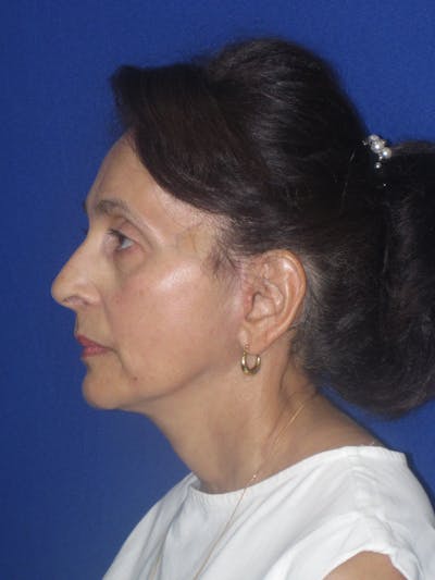 Facelift/Mini-Facelift Before & After Gallery - Patient 961689 - Image 8