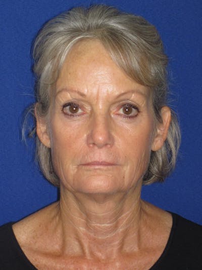 Facelift/Mini-Facelift Before & After Gallery - Patient 382768 - Image 1