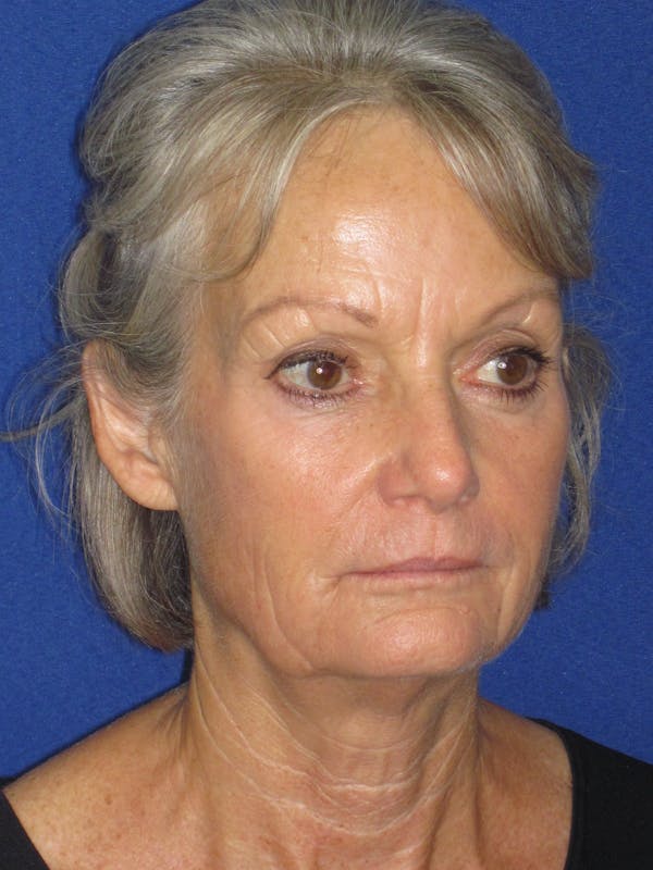 Facelift/Mini-Facelift Before & After Gallery - Patient 382768 - Image 3
