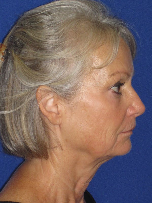 Facelift/Mini-Facelift Before & After Gallery - Patient 382768 - Image 7