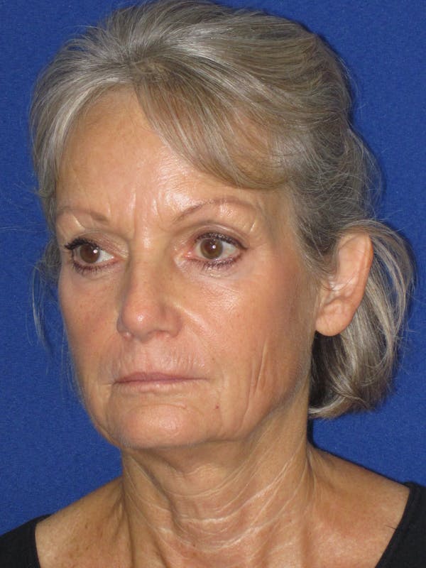 Facelift/Mini-Facelift Before & After Gallery - Patient 382768 - Image 5