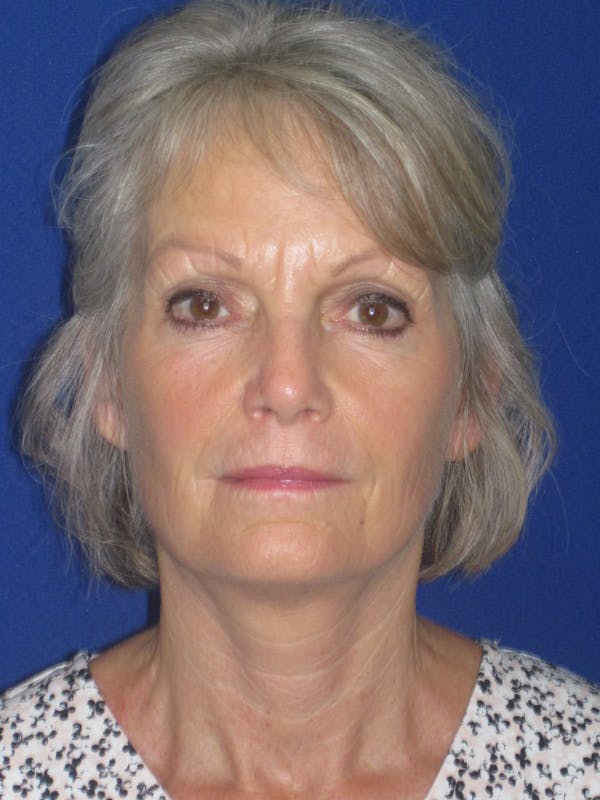 Facelift/Mini-Facelift Before & After Gallery - Patient 382768 - Image 2