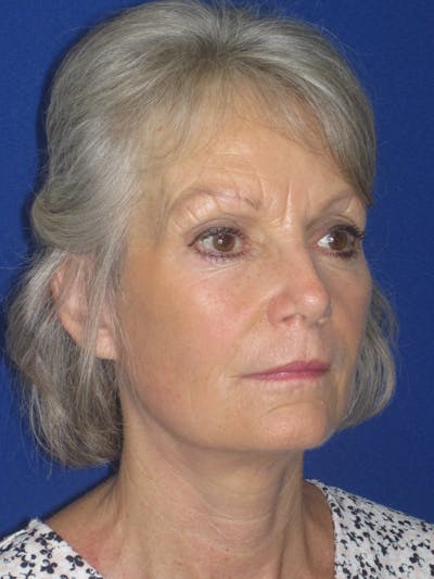 Facelift/Mini-Facelift Before & After Gallery - Patient 382768 - Image 4