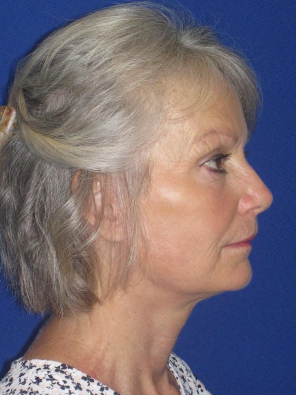 Facelift/Mini-Facelift Before & After Gallery - Patient 382768 - Image 8