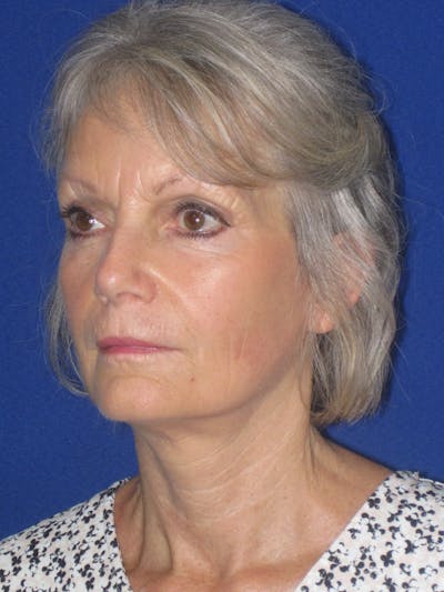 Facelift/Mini-Facelift Before & After Gallery - Patient 382768 - Image 6