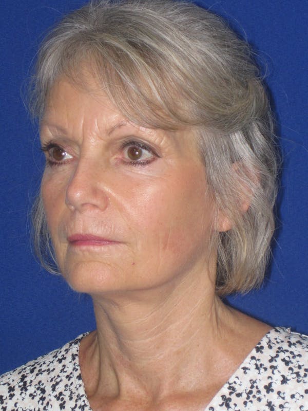Facelift/Mini-Facelift Before & After Gallery - Patient 382768 - Image 6