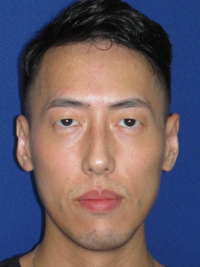 Otoplasty 