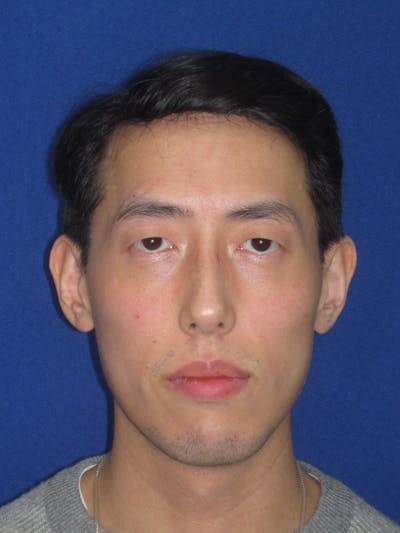 Otoplasty 