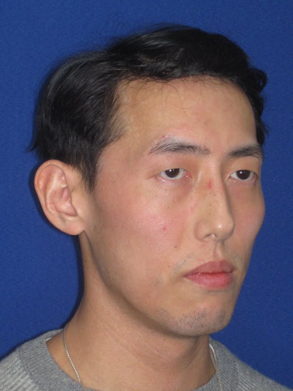 Otoplasty 