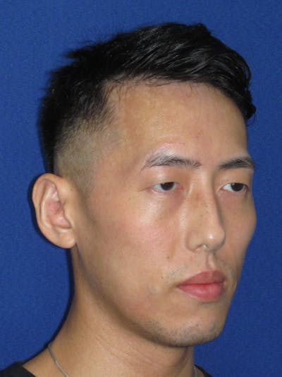 Otoplasty 