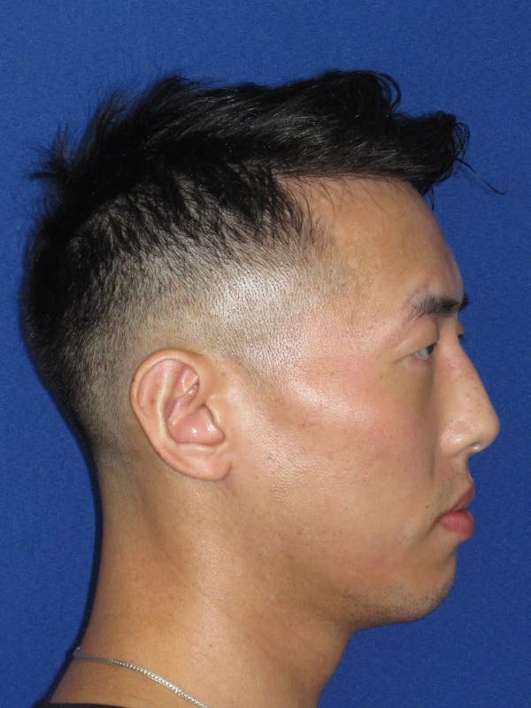 Otoplasty 