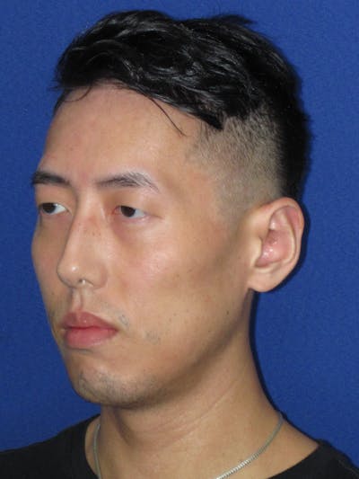 Otoplasty 
