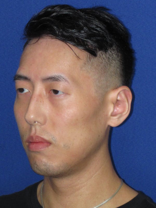 Otoplasty 